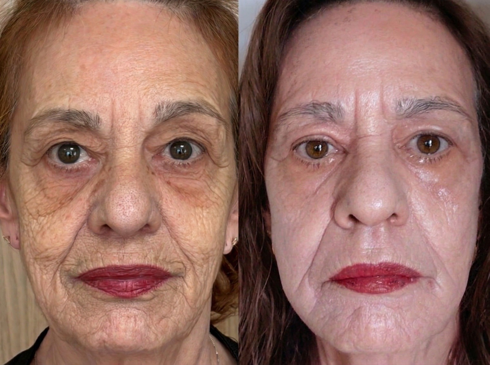 Paciente tratada com Neoxel CO2 — rugas e flacidez facial