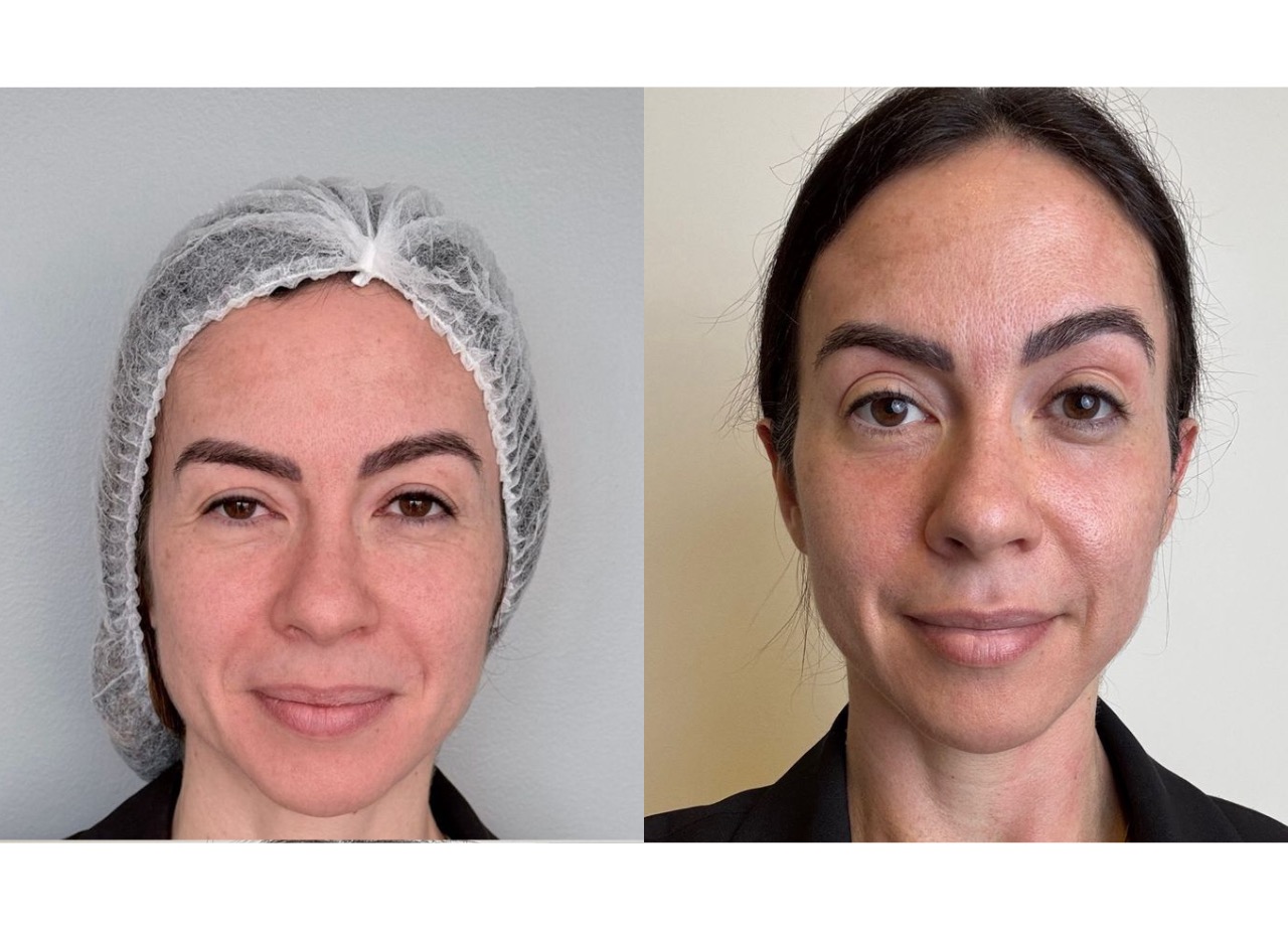 Paciente tratada com Neoxel CO2 — rejuvenescimento facial